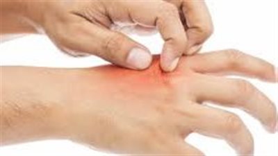 ما حساسية الأدوية وكيفية علاجها