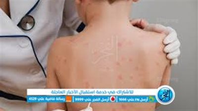 بعد تفشي جدري القرود بين الأطفال.. اعرف الأعراض وطرق الوقاية