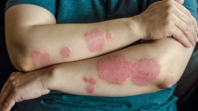 هاني الناظر يكشف عن أعراض وأنواع الصدفية وهل هي مرض معد (فيديو)