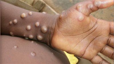 الولايات المتحدة ترفع حالة الطوارئ الصحية بسبب جدري القرود