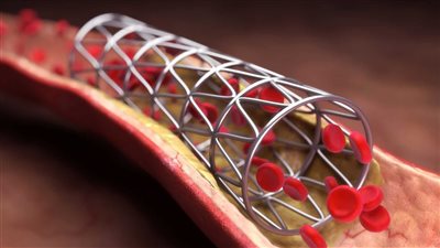 هل يستمر مريض دعامات القلب على الدواء مدى الحياة؟.. حسام موافي يجيب (فيديو)