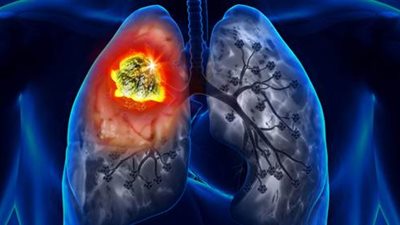 أستاذ علاج الأورام توضح الأعراض المبكرة لسرطان الرئة (فيديو)