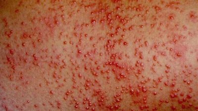 مع ارتفاع الحرارة.. هاني الناظر يقدم نصائح للوقاية من حمو النيل (فيديو)