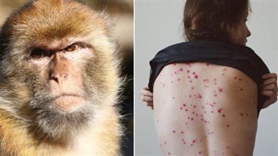 أستاذ علم أحياء دقيقة: جدري القرود لا ينتقل إلا بين المثليين (فيديو) 