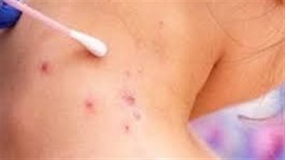 كيفية التعامل مع مرضى جدري القرود