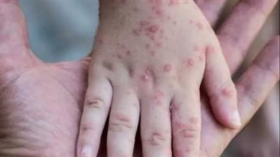 بعد اكتشاف أول حالة في مصر.. استشاري المناعة يطمأن الناس حول جدري القرود