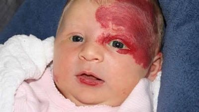 الوحمة الدموية على جفن العين.. خطورتها وأنواعها وطرق علاجها