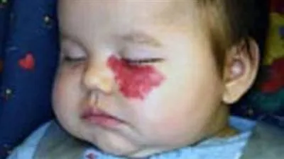 طرق علاج الوحمة الدموية