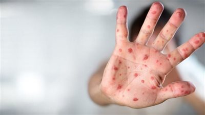 المراكز الأمريكية: جدرى القرود يتراجع عالميًا