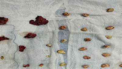 استخراج 49 حصوة وإصلاح ناسور مراري معقد بقنا