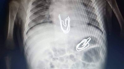 جراحة منظار بمستشفى الأطفال بالمنصورة تنقذ طفل 3 أشهر ابتلع 