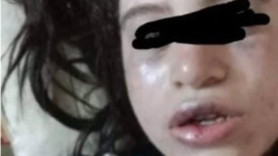 أب وزوجته يعتدون بالضرب المبرح والحرق لطفلين للزوجة الأولى ببورسعيد