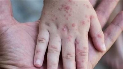 بعد رصد إصابة جديدة بـ جدري القردة بمصر.. تعرف على أبرز الأعراض