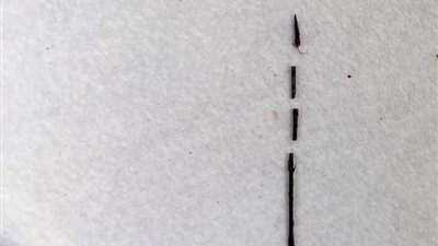 استخراج إبرة تنجيد من مريض ظلت في ظهره عامين ببنها الجامعي