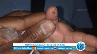 إصابة طفلة بصعق كهربائي بكابل مكشوف بممشى النصر (صور)