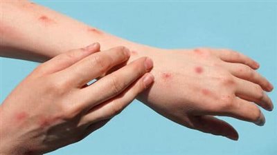 حقيقة وصول جدري القرود مصر.. وتعليمات هامة من الصحة بشأن المصابيين