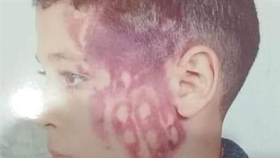 تفاصيل إصابة تلميذ على يد مدرس في مدرسة بالدقهلية 