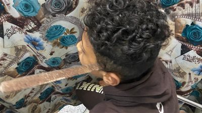 بعد 4 ساعات بالعمليات.. طوارئ المنصورة تنزع مبرد حديد من رأس طفل بسبب مشاجرة