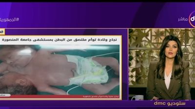 مدير مستشفى المنصورة الجامعي يكشف تفاصيل نجاح ولادة توأم ملتصق من البطن