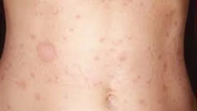 كان سبب في وفاة عزيز الأحمد.. ماذا تعرف عن مرض GHD؟