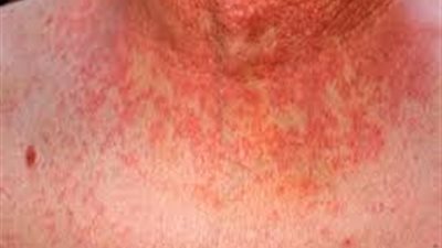 ما لا تعرفه عن الحمى المالطية وأعراضها؟