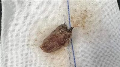 تفاصيل وفاة رضيع ابتلع قطعة فراولة في بنها