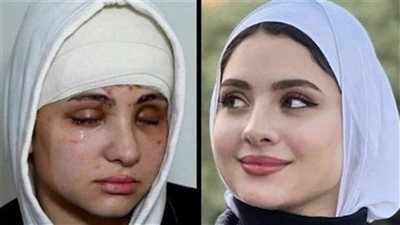 بعد فقدها بصرها نهائيًا.. القصة الكاملة لأزمة البلوجر سارة محمد