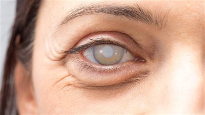 طبيب يُحذر من خطأ لمرضى حساسية العين يسبب الإصابة بالمياه البيضاء (فيديو)