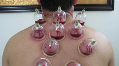 الحجامة طب نبوي يواجه حقيقة الفهم العملي الحديث