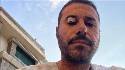 أخذت 3 غرز في الجفن