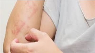 ما هو مرض حساسية القمح وطريقة الوقاية منه؟