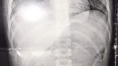 إنقاذ طفلة ابتلعت خرزة شخشيخة أطفال ببنها الجامعي