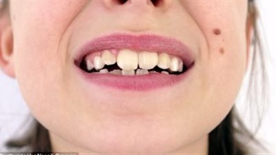 نصائح لتفادى مشاكل الأسنان عند تناول كحك العيد