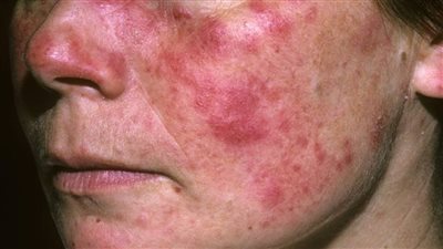 أستاذ روماتيزم يوضح أعراض وأسباب الإصابة بمرض الذئبة الحمراء (فيديو)