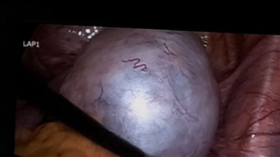 فك تداخل تليسكوبى بالامعاء دون تدخل جراحى لطفل بالدقهلية |صور