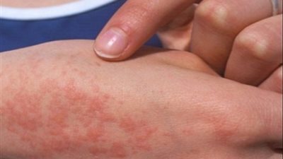 تونس: رصد 8 إصابات بمرض الحمى المالطية في ولاية باجة 