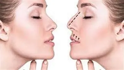 للمقبلات علي عملية تجميل الأنف.. كل ما تحتاجين معرفته هنــا