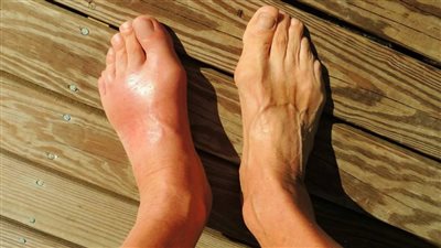 هيئة الدواء تكشف مفاجأة عن أشهر أسباب الإصابة بالنقرس