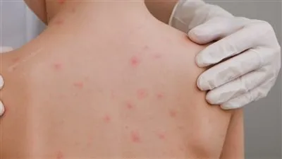 حفاظا على الأطفال.. تعرف على تفاصيل انتقال عدوى الجديري المائي (فيديو)