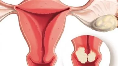 أورام عنق الرحم.. أعراضها أسبابها وطرق الوقاية منها