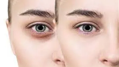 هل تريدين عيون جميلة خالية من التعب والهالات السوداء؟.. إليكِ هذا الإجراء!