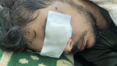 هجم عليه مسجلين خطر.. شاب يفقد عيناه الاثنين بطلق خرطوش 