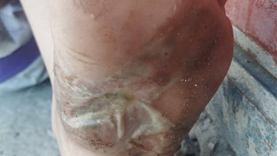 حرق طفلتين وتعذيبهما بالنار في قنا.. والمتهمان 