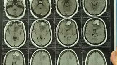 تعاني من اضطرابات شديدة.. نجاح جراحة استئصال ورم في المخ لسيدة بالإسكندرية 