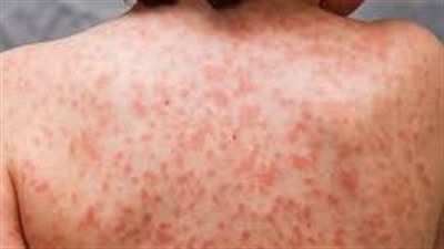 كيف تتم مواجهة الأمراض والأوبئة المنتشرة في العالم؟.. أطباء يجيبون 