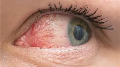 4 علاجات المنزلية لجفاف العين