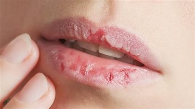 9 نصائح للوقاية من تشقق الشفاه تزامنا مع دخول الشتاء