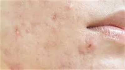 أسباب وعوامل ظهور حبوب الوجه في الذقن