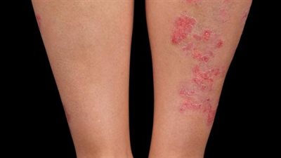 الإكزيما العصبية.. تعرف عليها وأسبابها وأعراضها