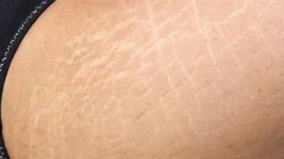 ما هي الخطوط البيضاء وما أسباب ظهروها في الجسم؟